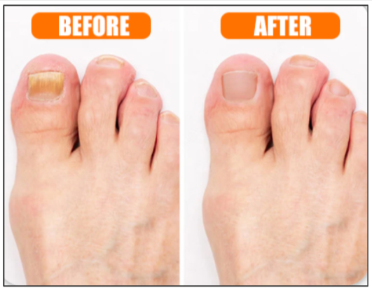 Hewelth BioClear Nails Benefit