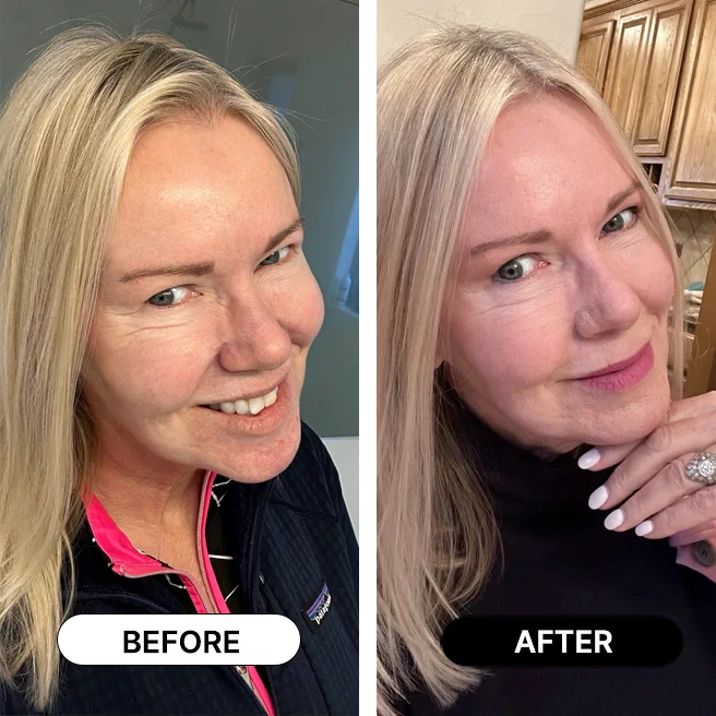 South Beach Collagen Filler Serum Before Vs After